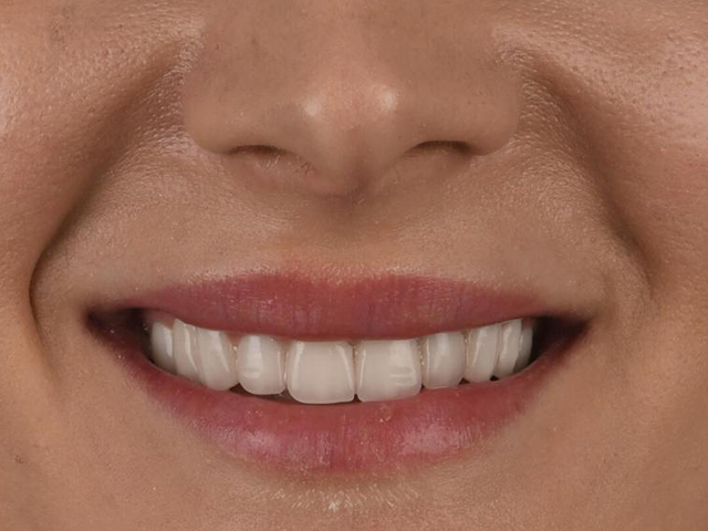 Hollywood Smile & E-Max Lamine Veneer - NACHHER