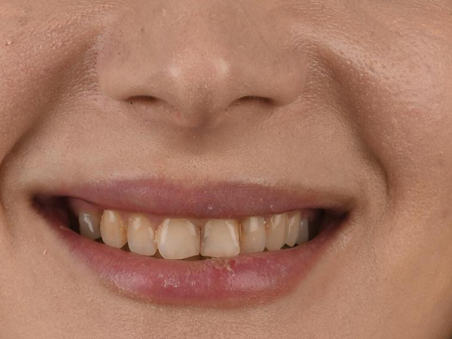 Hollywood Smile & E-Max Lamine Veneer - VORHER