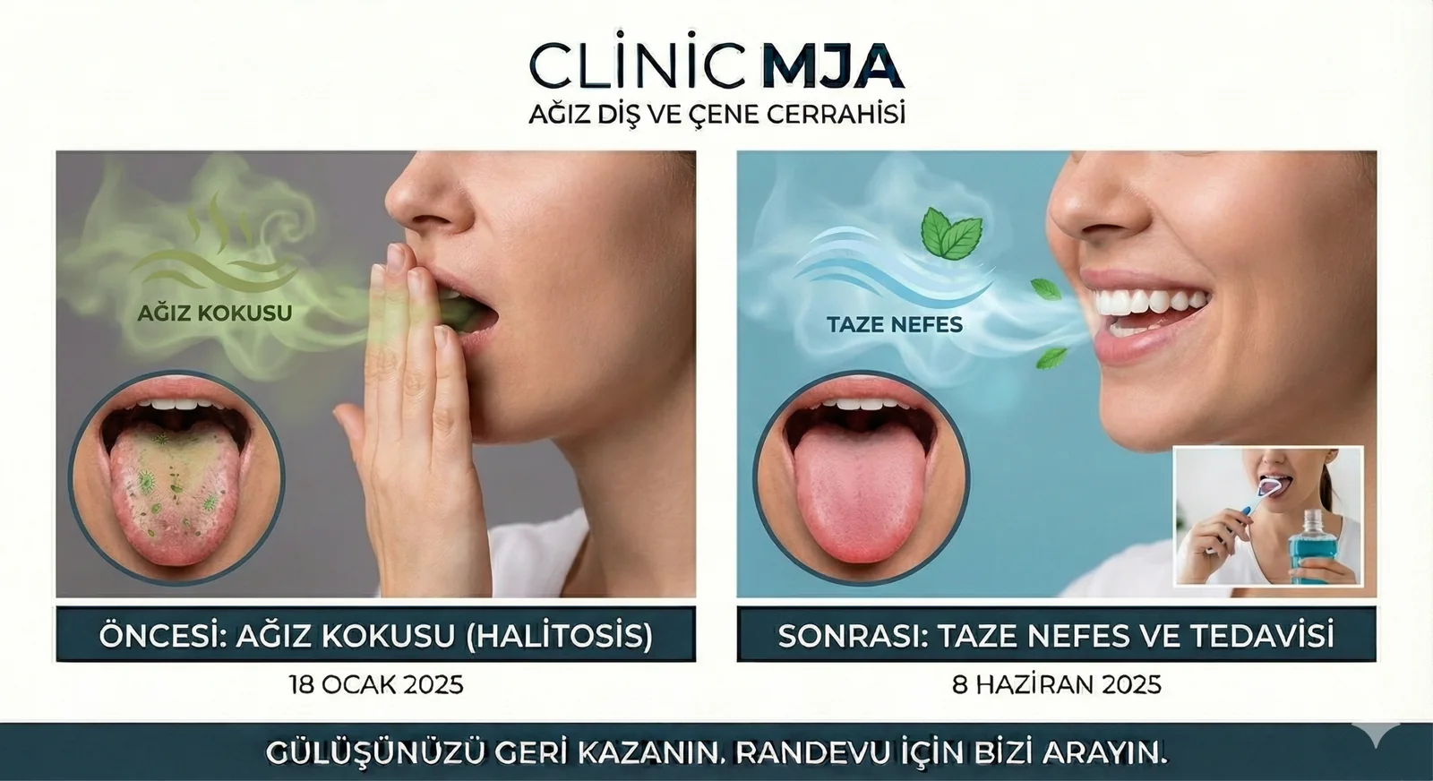 Halitosis & Mundgeruch-Therapie