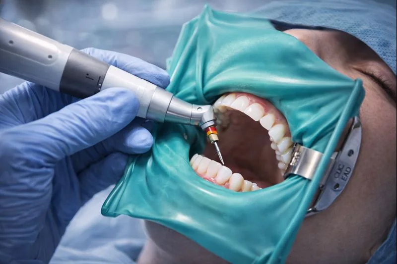 Endodontie & Wurzelkanalbehandlung